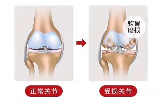 Move Free骨胶原的功用与作用是什么？构建关节软